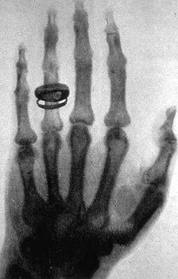 255px-X-ray_by_Wilhelm_R%C3%B6ntgen_of_Albert_von_K%C3%B6lliker%27s_hand_-_18960123-02.jpg